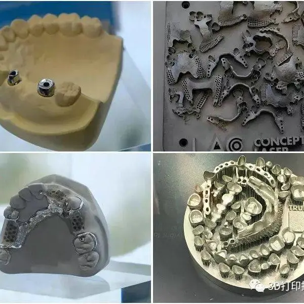 生物医疗3D打印 牙齿内冠3D打印 金属义齿3D打印 钛合金3D打印